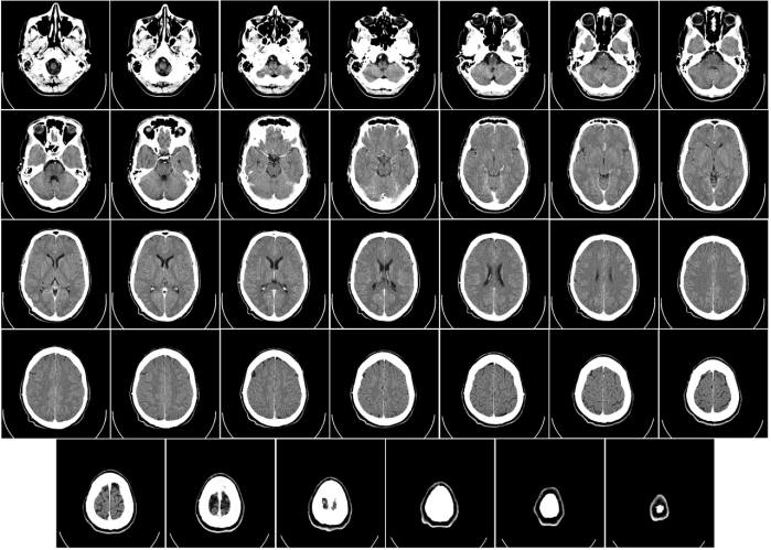 Recordando el futuro: Don Quijote y la sinestesia oculta del ajedrez 2 Cortes cerebrales, Ct Scan. Imagen: Mikael Häggström (CC)