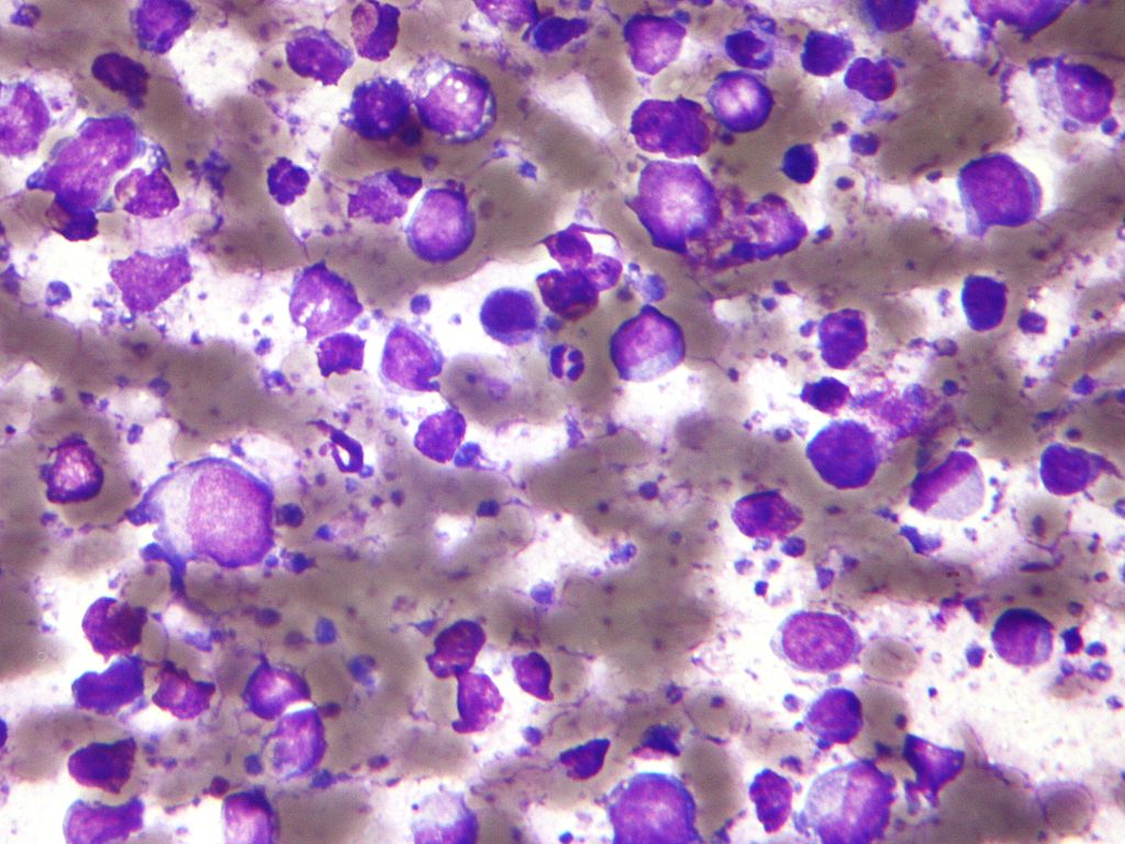 Micrografía de un linfoma difuso de células B grandes. Imagen: Nephron (CC)