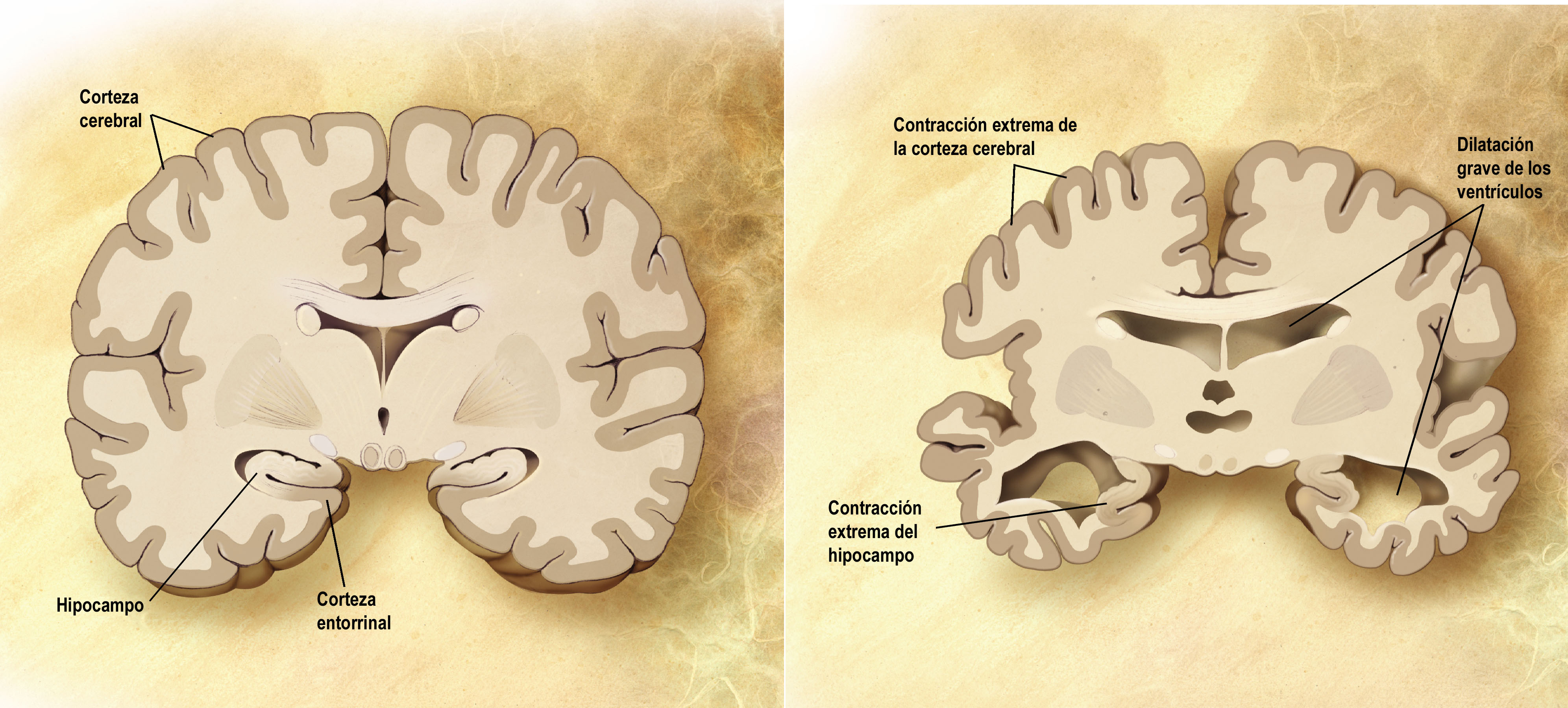 Esquema de un corte frontal de dos cerebros. A la izquierda un cerebro sano y a la derecha uno que padece alzhéimer. Imagen: DP
