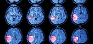 Imagen cortesía de brainspinesurgery.