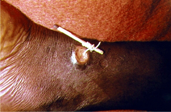 Dracunculus medinensis siendo extraído a través de la piel. Foto: Public Health Image Library (CC)