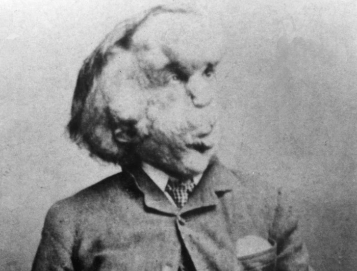 Retrato de Joseph Merrick. Imagen: DP.