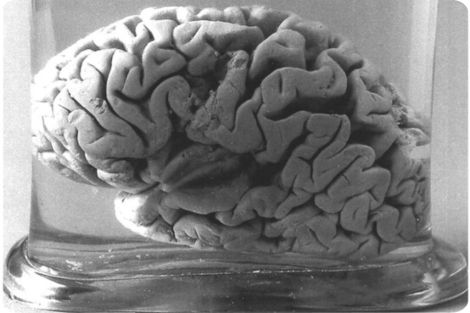 Cerebro de Louis Victor Leborgne (wikimedia commons)